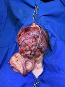 Tumor-Hepatico-Micas