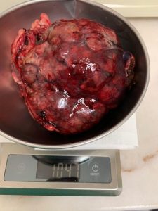 Tumor-Micas-e1569411384605