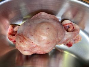 Tumor_uterino